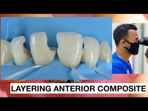 Step by step Layering Anterior Composite | General Dentist Griya RR