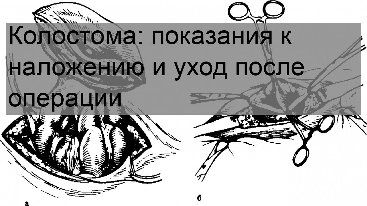 Колостома: показания к наложению и уход после операции