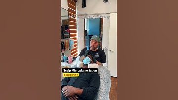 Scalp Micropigmentation Session One #smp #edmonton scalpmicropigmentation #smptraining