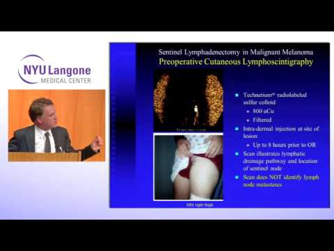 Surgical Treatment of Malignant Melanoma