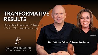 Transformative Results Deep Plane Lower Face Neck Lift Sciton Trl Laser Resurfacing