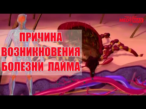 Причины болезни Лайма (клещевой боррелиоз, Лайм-боррелиоз)