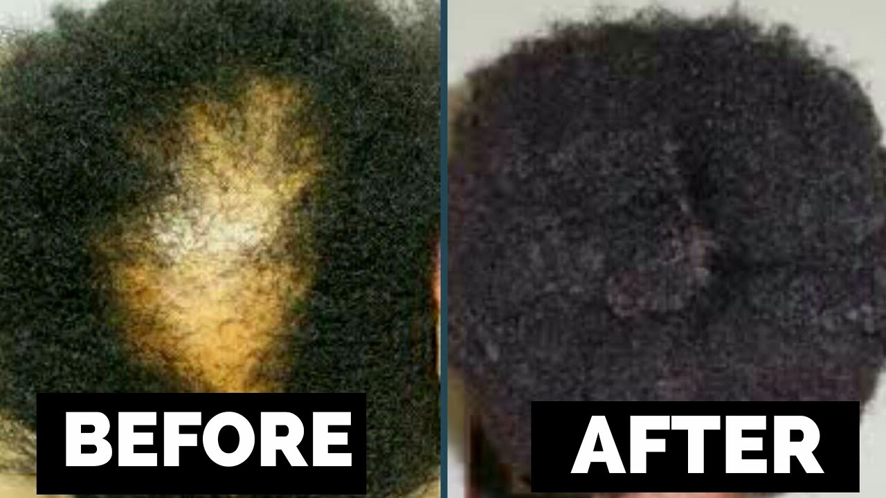 REGROW YOUR BALD EDGES or SPOTS FAST with this POWERFUL ONION TREATMENT