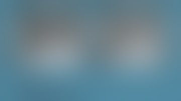 Robotic Left Lower Lobe Split Lateral (S9) and Posterior (S10) Basal Bisegmentectomy