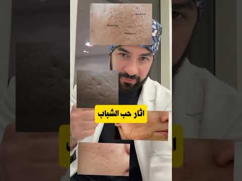 علاج اثار حب الشباب التصبغات والحفر والندبات بالليزر و تقطيع الالياف