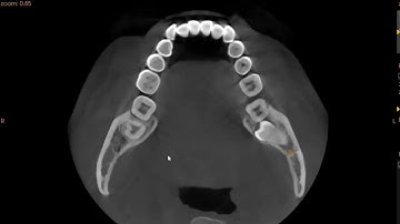 RJ - Dr. IQ (Wisdom tooth association with inferior alveolar nerve)