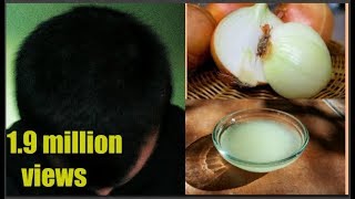 प्याज का  रस  इस प्रकार लगाने से होगा पूरा फायदा ॥ Onion Juice For Hair Loss And Hair Grow.