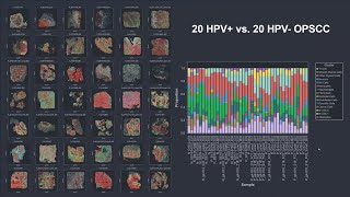 Decoding the Tumor Microenvironment in Head and Neck Cancer with the G4X In Situ Multiomics Platform