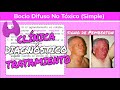 ⚕️🩺 BOCIO DIFUSO NO TÓXICO o BOCIO SIMPLE: Síntomas, Díagnostico y Tratamiento