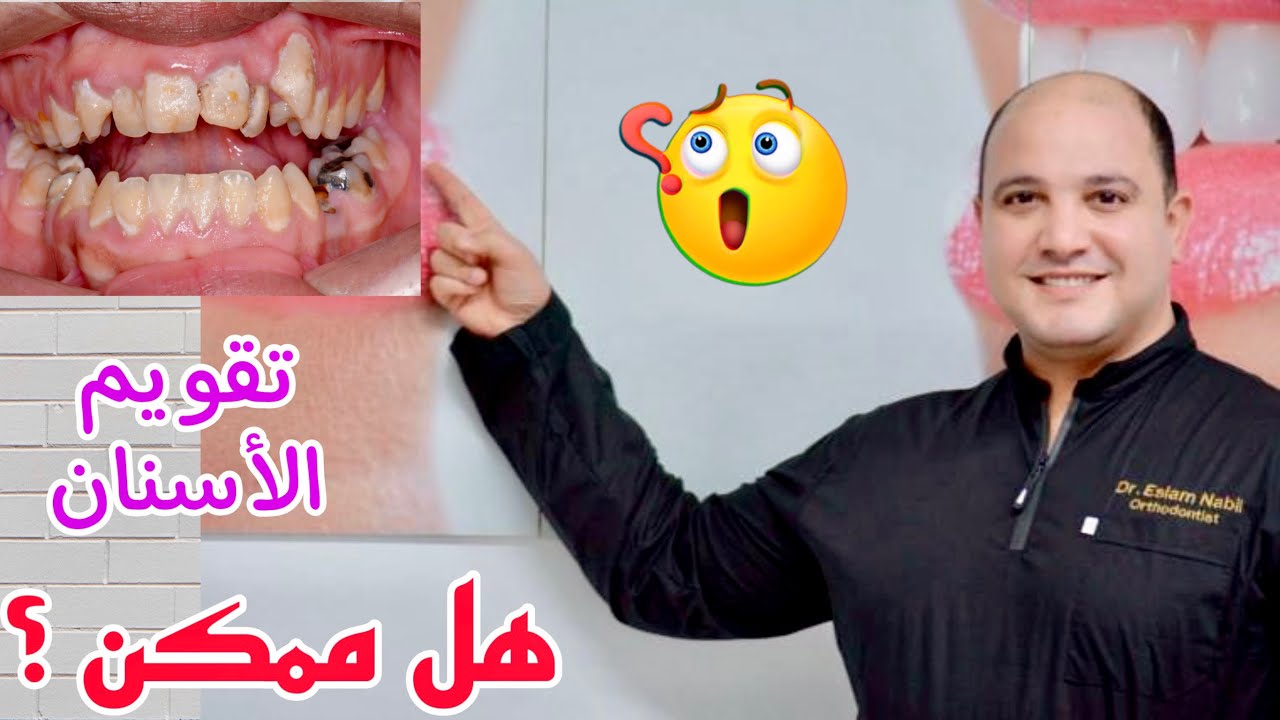 هل ممكن تقويم الأسنان | في وجود تسوس الأسنان و جير الأسنان | تقويم الدايمون | ناب بارز