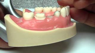 3/4 crown 3 unit FDP prep