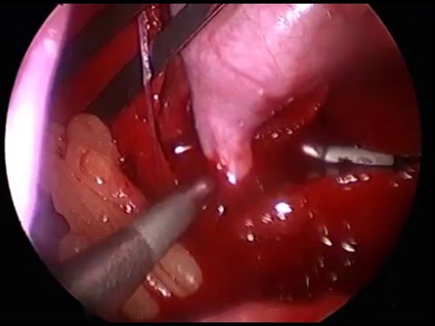Surgical Video Laparoscopic Gall Bladder Removal Youtube
