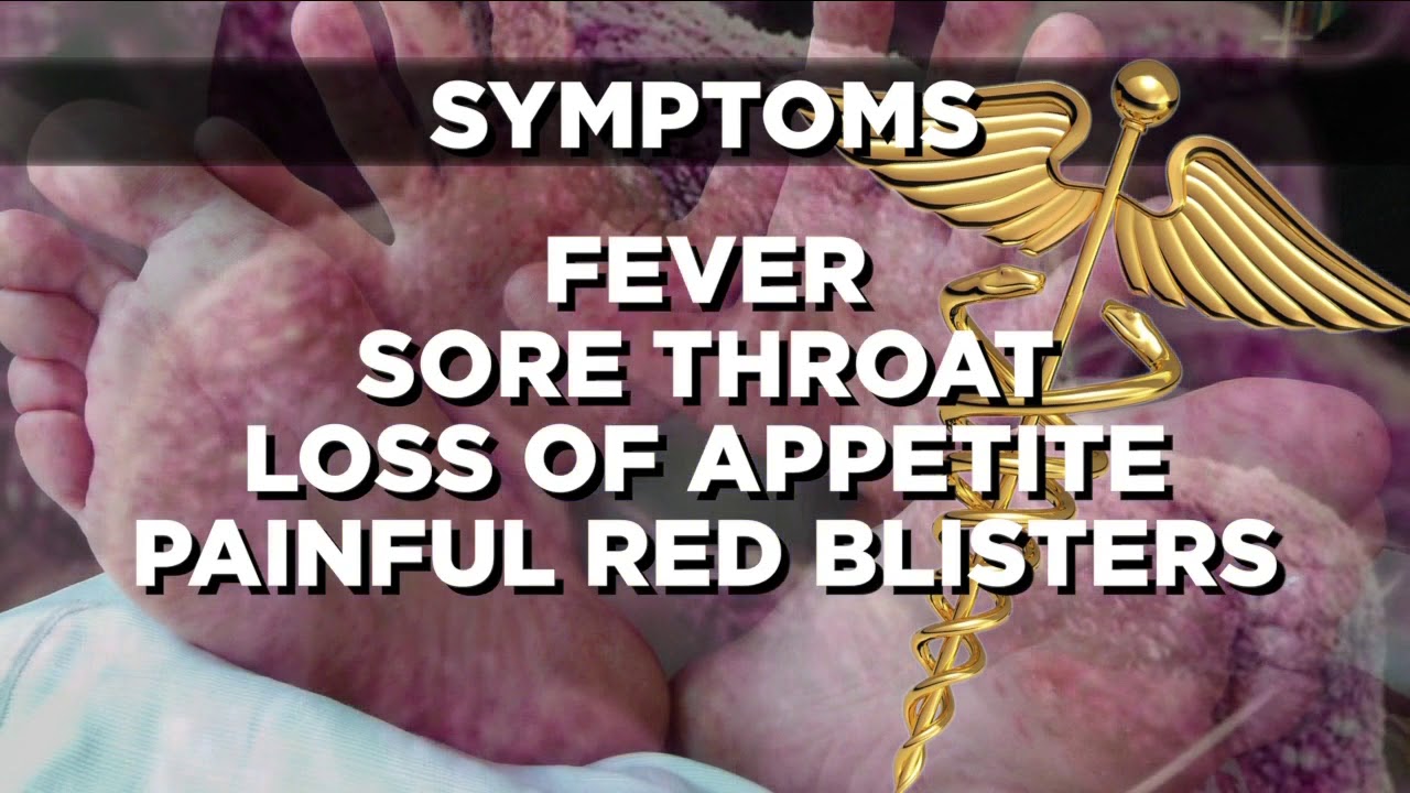 Hand, Foot & Mouth Disease symptoms; 'Miserable virus' spreads in MI