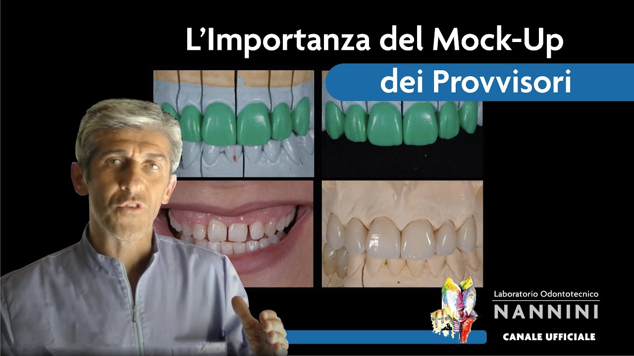 |* VIDEO CORSO *| Importanza del Mock-up dei provvisori nella protesi