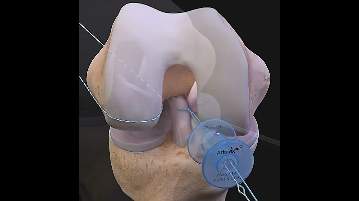 ACLtear.com - Arthrex ACL Repair - DayDayNews