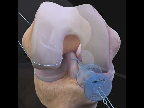 ACLtear.com - Arthrex ACL Repair