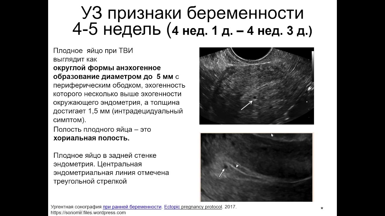 5 неделя беременности: ощущения женщины