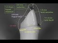 ANTERIOR PFM PREPARATION