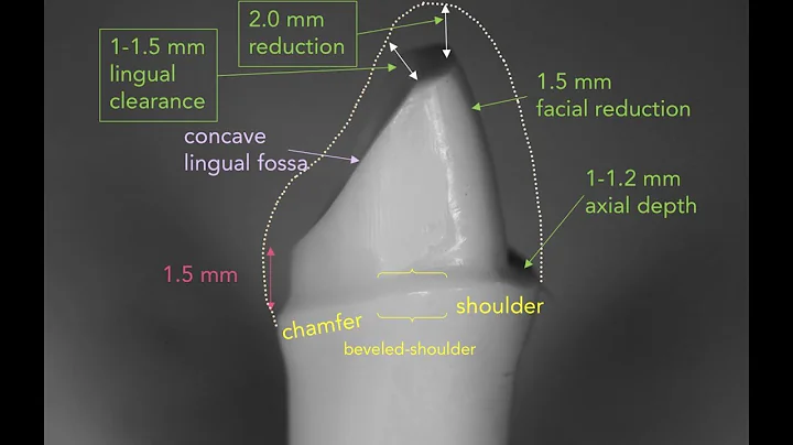 Anterior PFM Preparation | Dr. Richard Stevenson