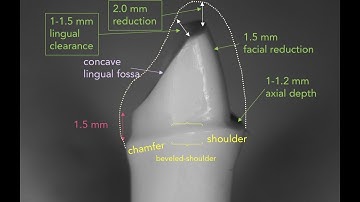 Anterior PFM Preparation | Dr. Richard Stevenson