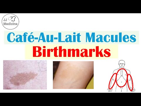 Café-au-Lait Spots The Hidden Clues Your Skin Is Trying to Tell You