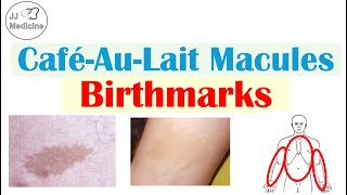 Café-au-Lait Spots: The Hidden Clues Your Skin Is Trying to Tell You