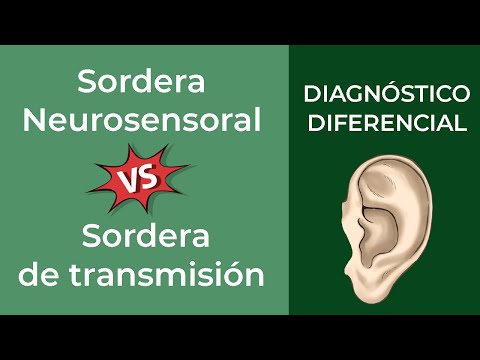 Diagnóstico Diferencial. Sordera Neurosensoral vs de transmisión