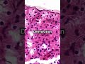 Acute kidney Injury , AKI