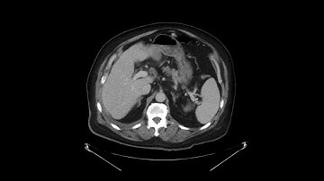 Pancreatic adenocarcinoma