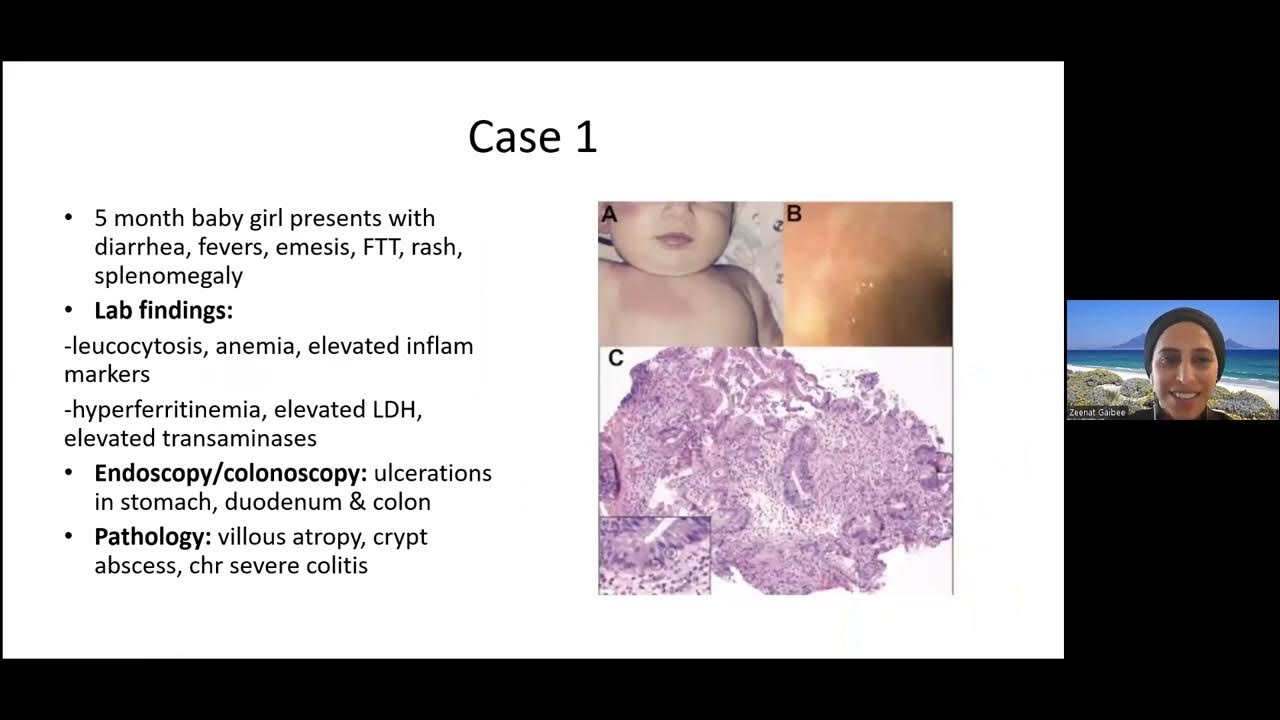  very early onset ibd veoibd and genetic manifestations in children