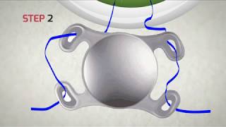 Step by Step - Canabrava 4 Flanged Technique with 6-0 Polypropylene Suture