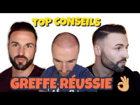 TOP CONSEILS pour une GREFFE FUE REUSSIE !!!!
