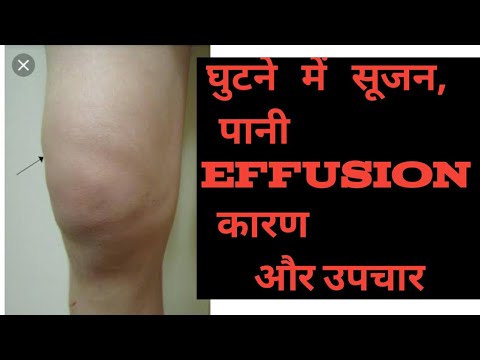 वीडियो: घुटने की सूजन का इलाज कैसे करें: 12 कदम (चित्रों के साथ)