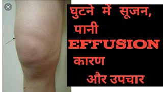 Swelling , edema, effusion in Knee  joint (Hindi ) घुटने में पानी भरना ,सूजन का इलाज knee pain #ACL screenshot 2