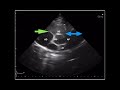 Ecocardiografía básica Tema 1: Planos ecocardiográficos