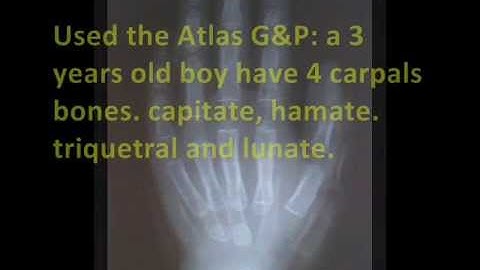 Radiological Case by Ricardo Arenas. Bone Age (2).