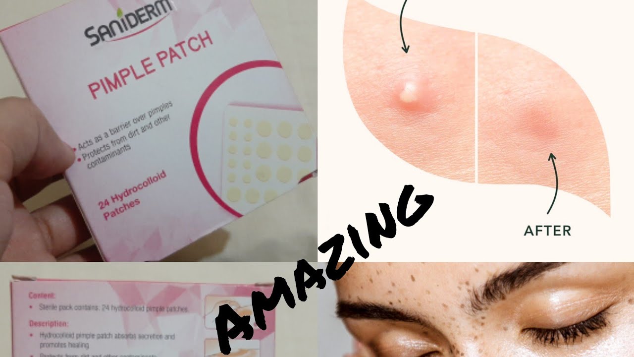 Saniderm pimple patch How to use review 