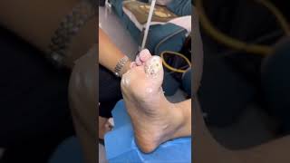 Plantar warts removal. That is hard to treat plantar wart. So many warts on the foot.