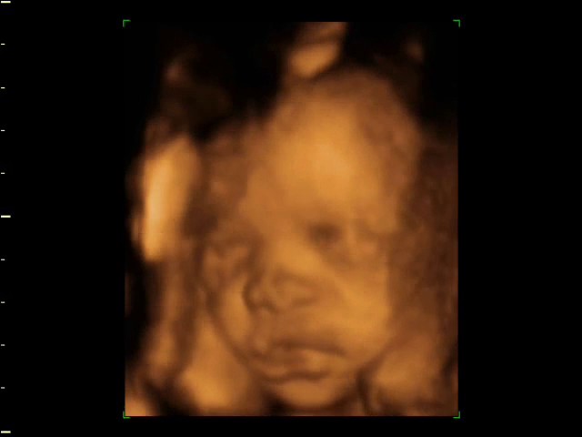 26 Week Baby Scan