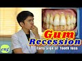 GUM RECESSION : Sign for Tooth Extraction?!!