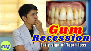 GUM RECESSION : Sign for Tooth Extraction?!!