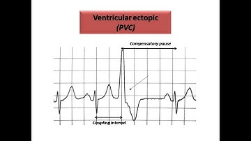 ECG course: Ectopics in ECG, Dr. Sherif Altoukhy