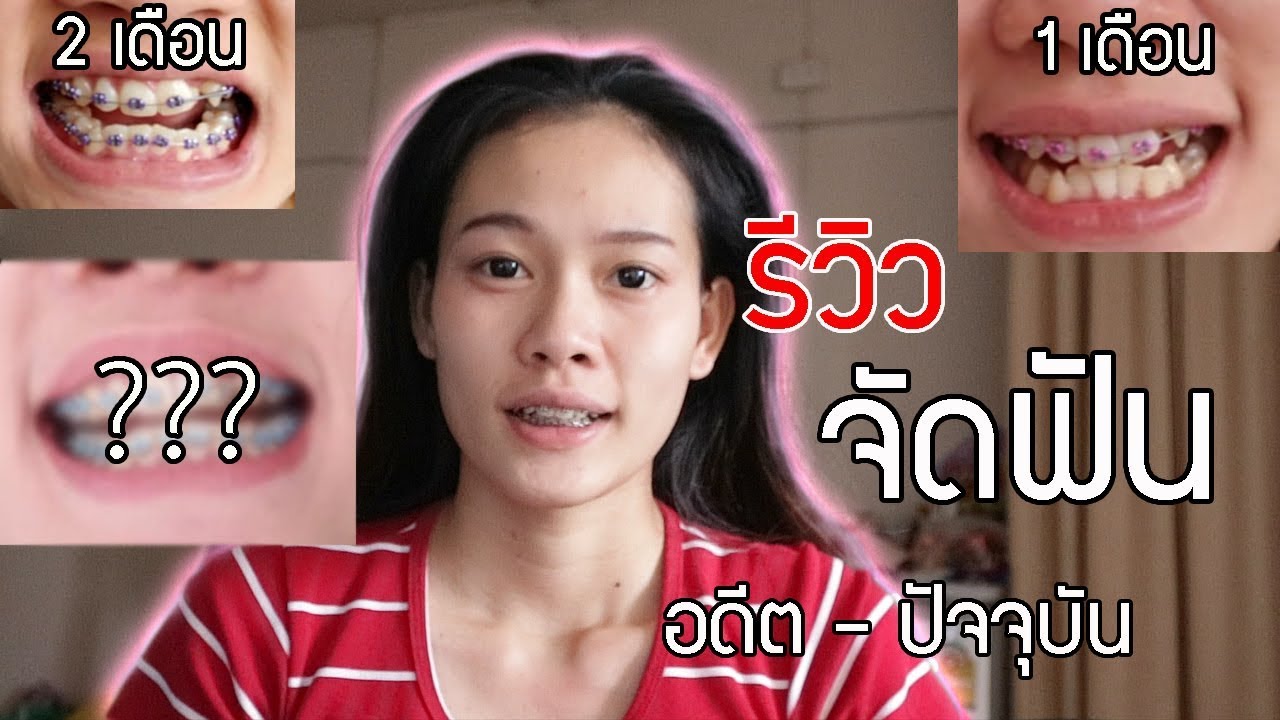 รีวีวจัดฟัน ดูการเปลี่ยนแปลงตั้งแต่ อดีต - ปัจจุบัน  l By Dow
