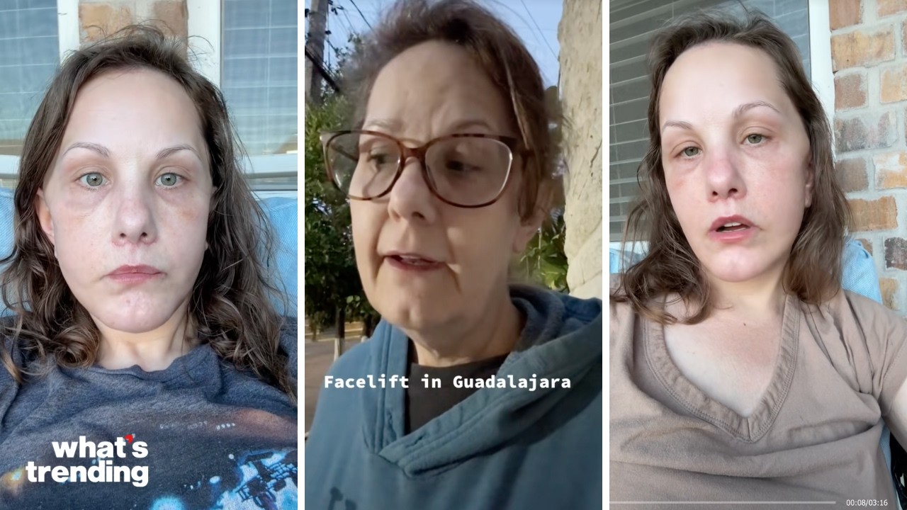 This $14K VIRAL FACELIFT Is Breaking the Silence Around Cosmetic Surgery