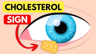High Cholesterol Can Affect Your Eyes - Here’s How