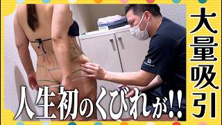【お腹＆腰 大量脂肪吸引】高BMIで他院は手術拒否→Dr.島…のサムネイル