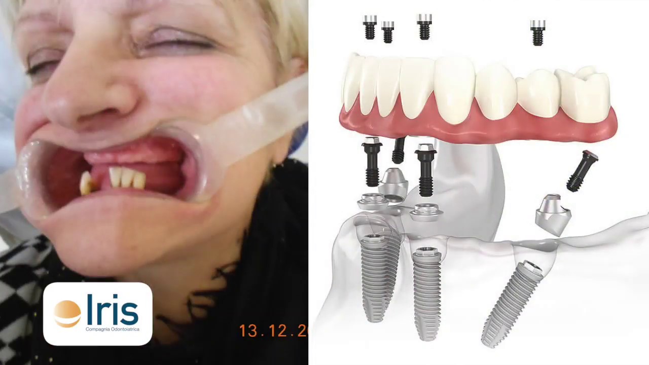 IMPIANTI DENTALI SENZA OSSO: La storia di Rossella di Aulla