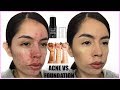 ACNE VS FOUNDATION: WET N WILD PHOTO FOCUS STICK FOUNDATION | Rocio Ceja