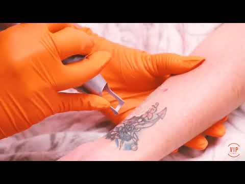 PicoLazer - Tattoo Removal