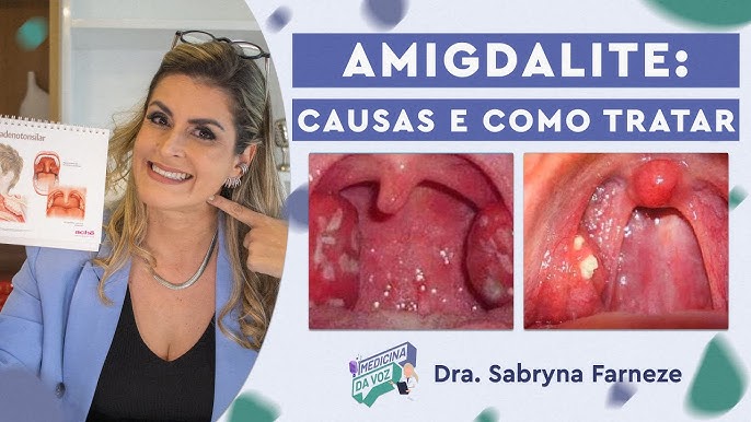 Você já ouviu falar do Caseum Amigdaliano? – Dr. Mohamad Saada Otorrino